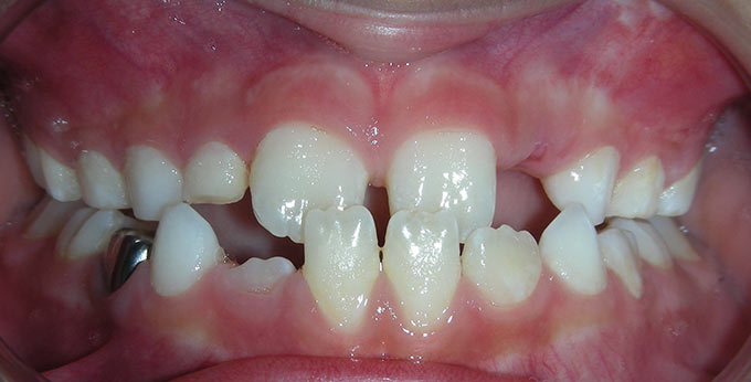 Child's teeth before orthodontic treatment for an underbite (Negative overjet) 